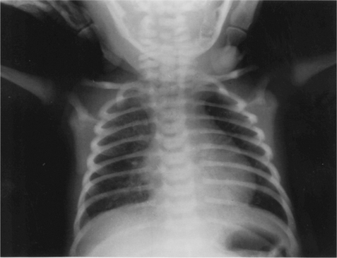 Paediatrics | Thoracic Key