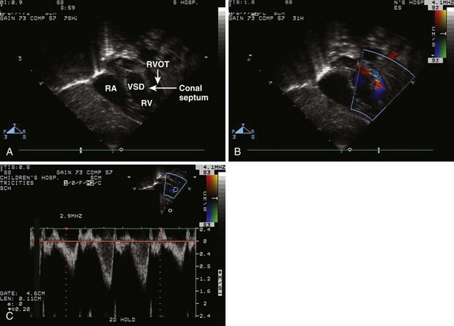 Conotruncal Lesions | Thoracic Key