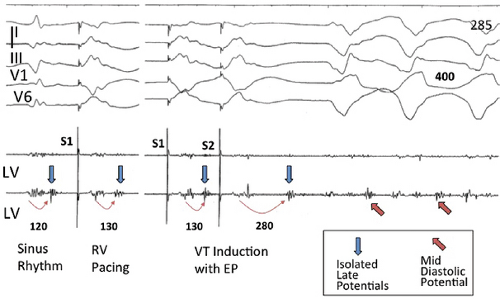 Recurrent Vvc Recurrent Ventricular Tachycardia | Thoracic Key