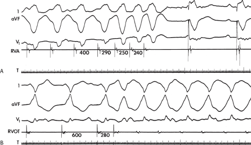 Recurrent Ventricular Tachycardia | Thoracic Key