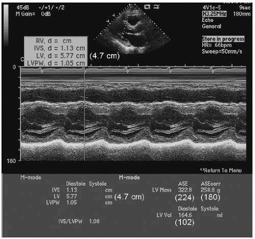 Evaluation of Systolic Function of the Left Ventricle | Thoracic Key