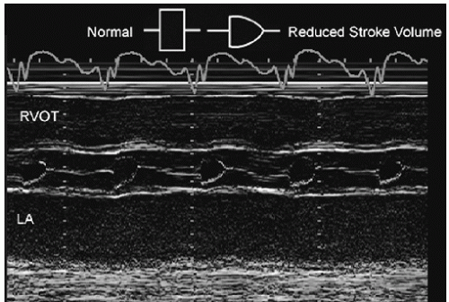 Evaluation of Systolic Function of the Left Ventricle | Thoracic Key