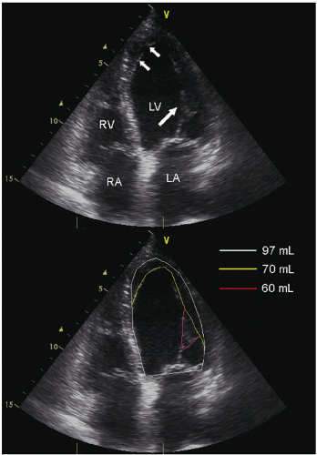Evaluation of Systolic Function of the Left Ventricle | Thoracic Key