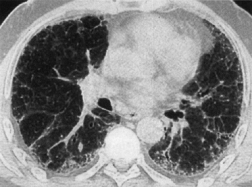 Diffuse Reticular Infiltrates Diffuse Lung Disease | Thoracic Key