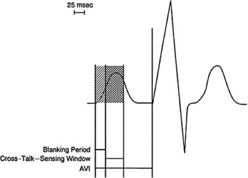 Cardiac Pacemakers | Thoracic Key