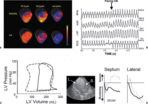 Left Ventricular Dyssynchrony and Cardiac Resynchronization Therapy ...