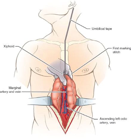 Colon Interposition | Thoracic Key
