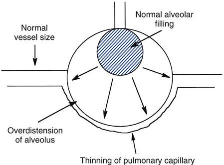 Effects of Positive-Pressure Ventilation on the Pulmonary System ...