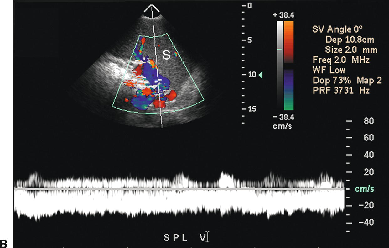 How To Measure Portal Vein On Ultrasound