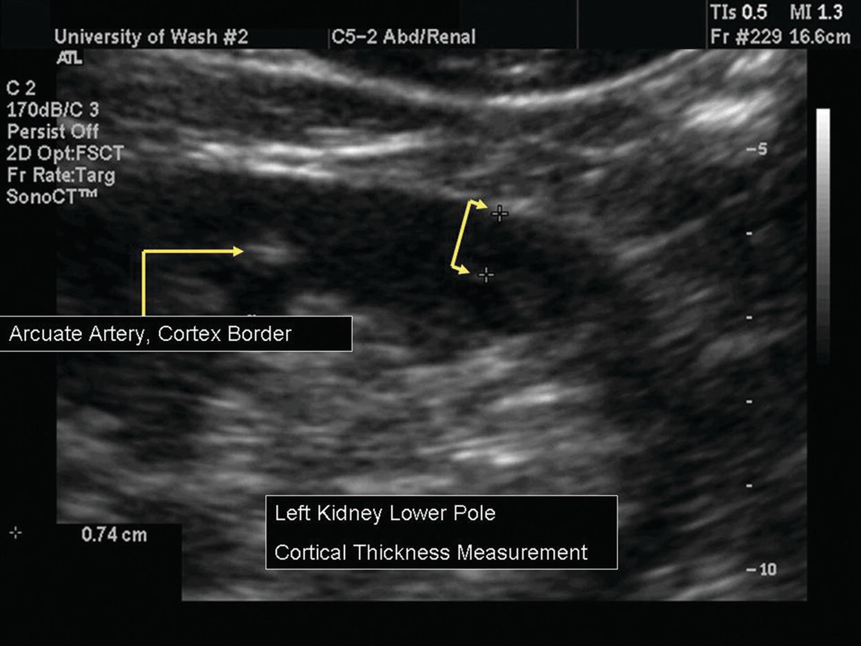 Renal Duplex Scanning Thoracic Key